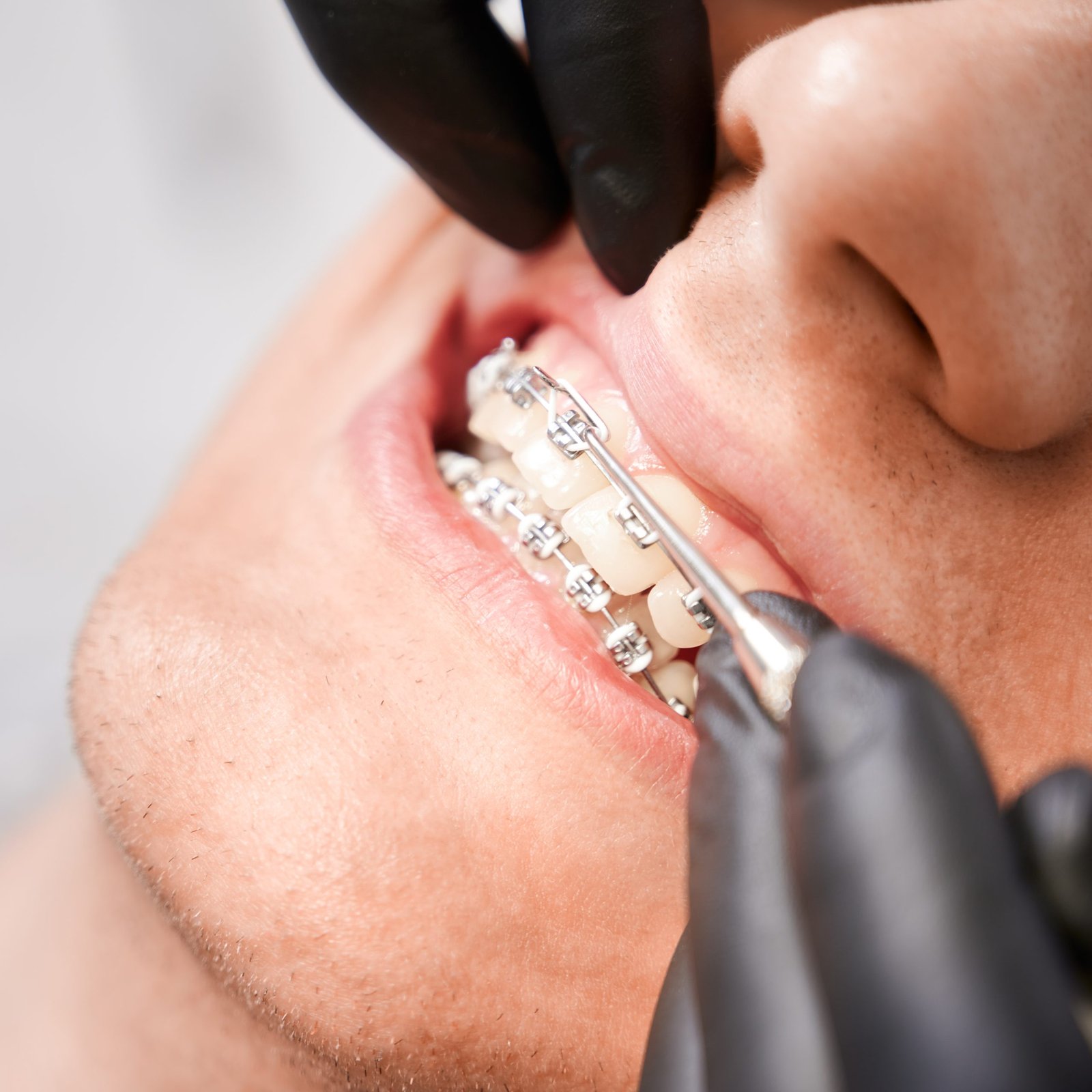 dentist placing rubber bands on male patient brace 2023 11 27 05 29 52 utc scaled 1